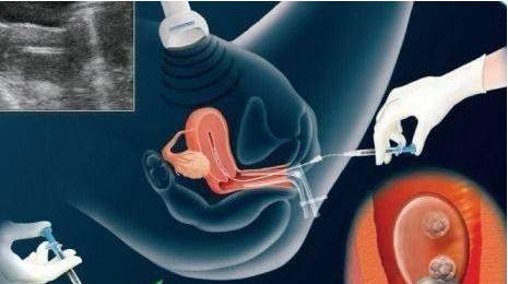 反复流产案例